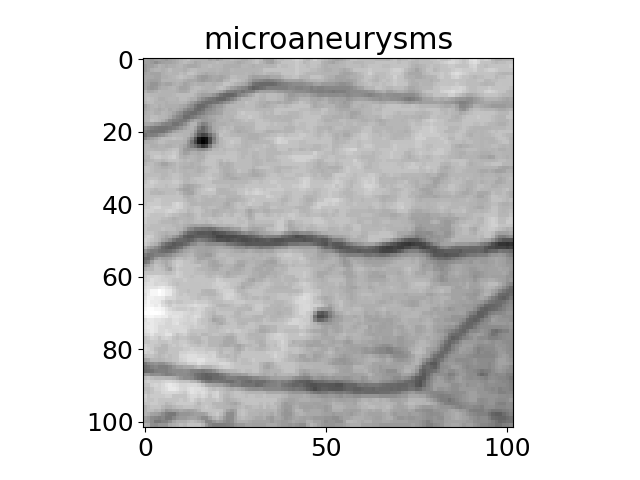 microaneurysms