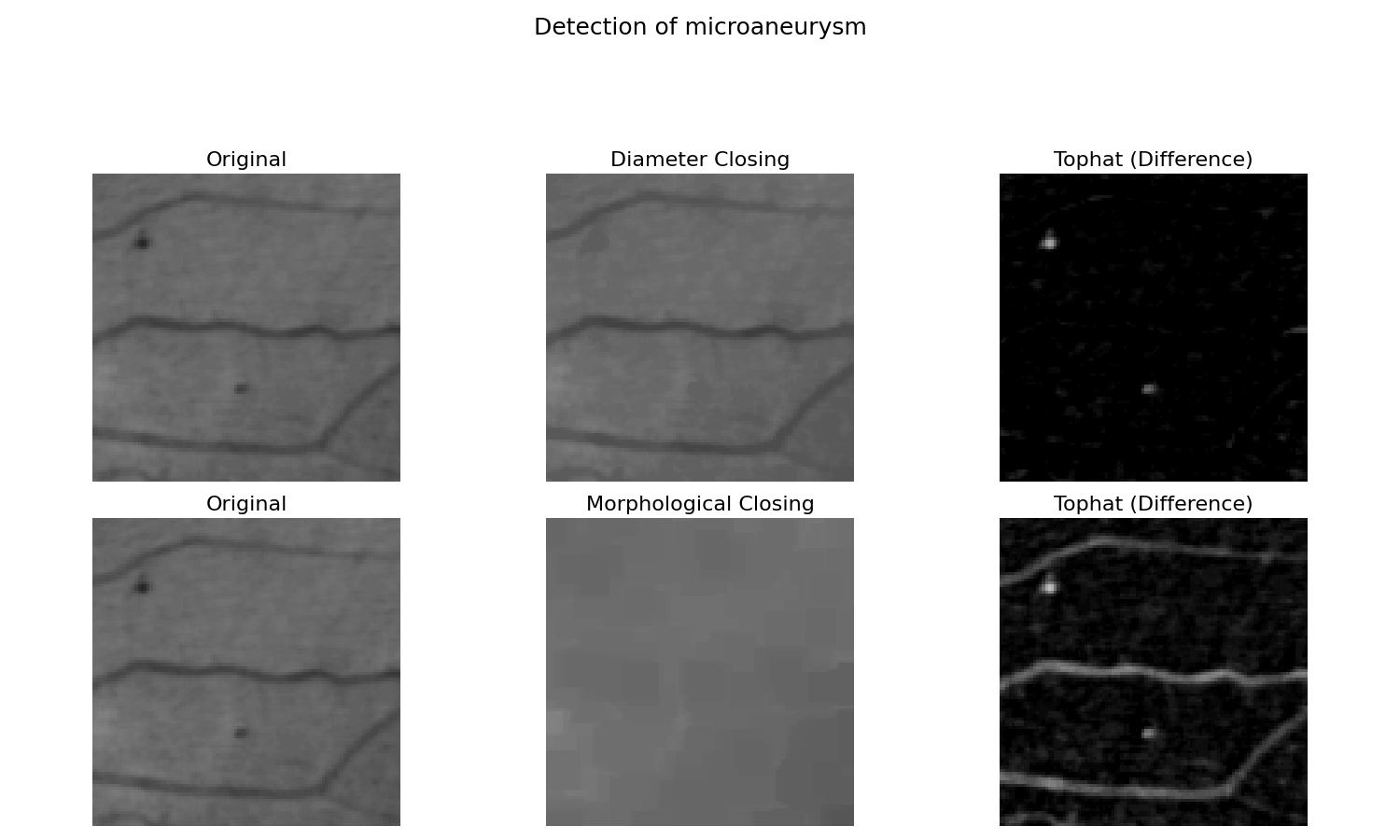Detection of microaneurysm, Original, Diameter Closing, Tophat (Difference), Original, Morphological Closing, Tophat (Difference)